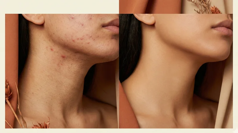 Comparaison avant-après traitement des poils incarnés sur la peau du visage